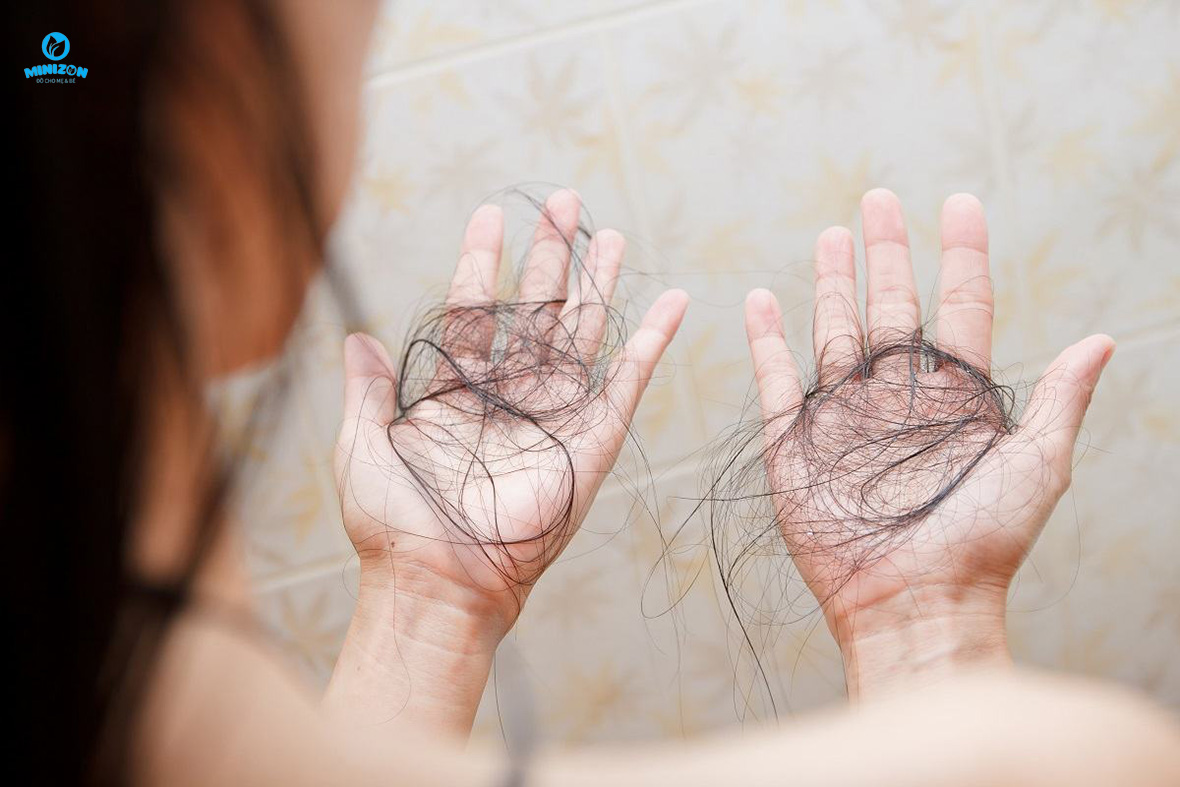 Thiếu máu – thiếu sắt gây rụng tóc sau sinh